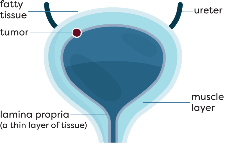 Muscle-Invasive Bladder Cancer Stage T2