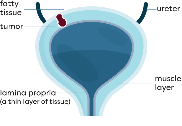 Muscle-Invasive Bladder Cancer Stage T3