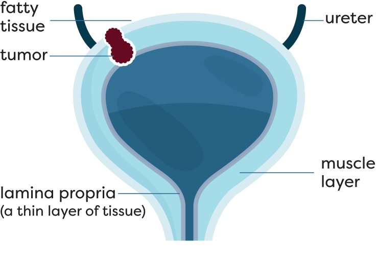 Muscle-Invasive Bladder Cancer Stage T4