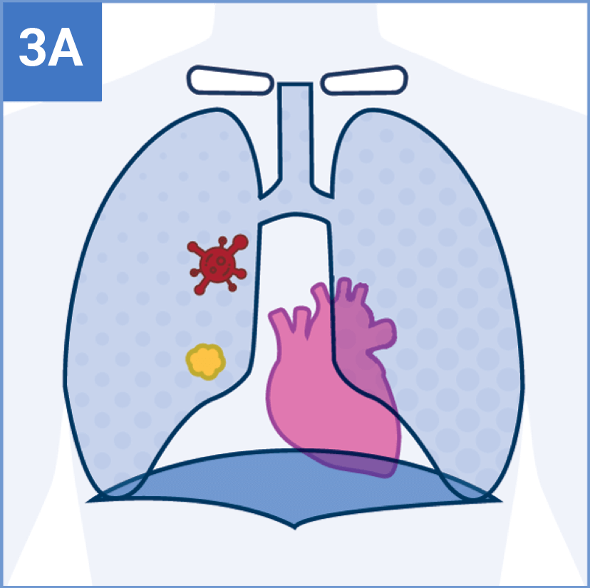Stage 3A Tumor Icon