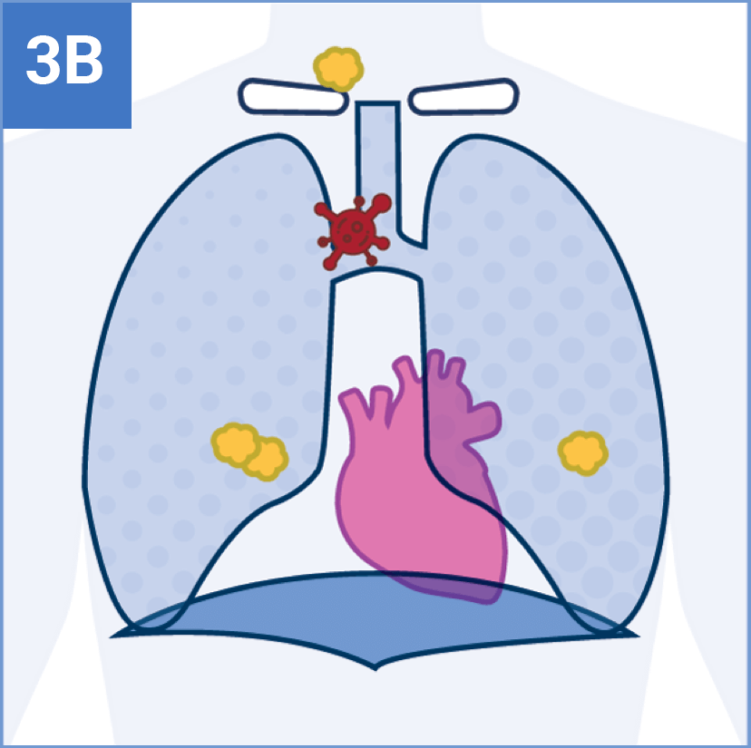 Stage 3B Tumor Icon