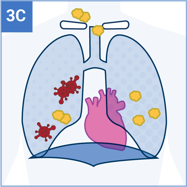 Stage 3C Tumor Icon