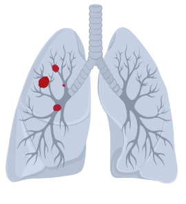 Limited-stage small cell lung cancer (LS-SCLC)