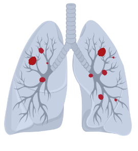 Extensive-stage small cell lung cancer (ES-SCLC)
