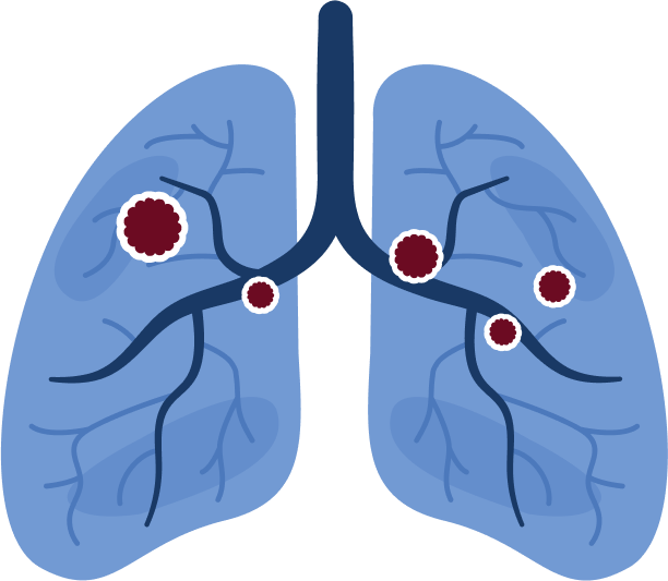 Extensive-Stage Small Cell Lung Cancer (ES-SCLC)