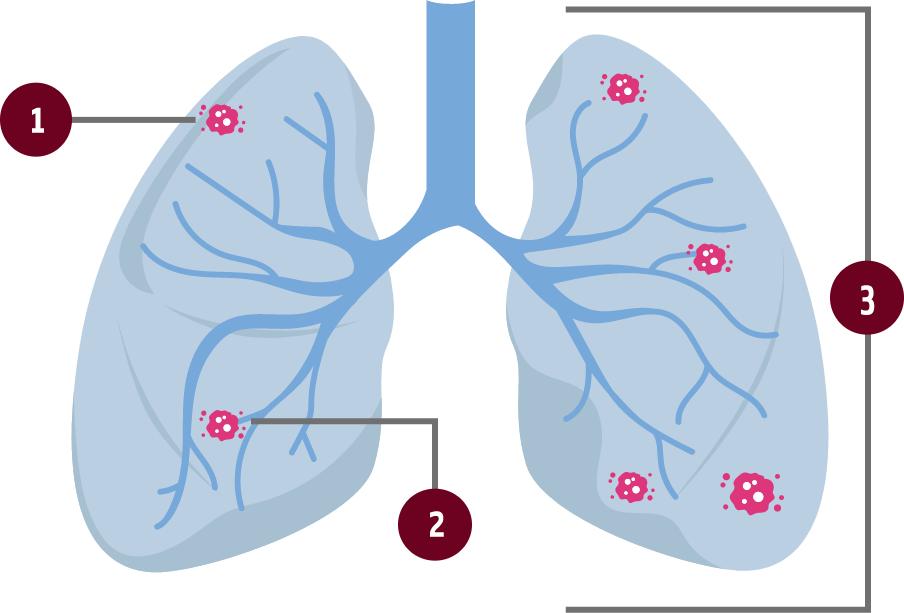 Different Types of Non-Small Cell Lung Cancer